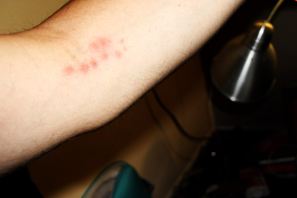 bed bug bites on arm