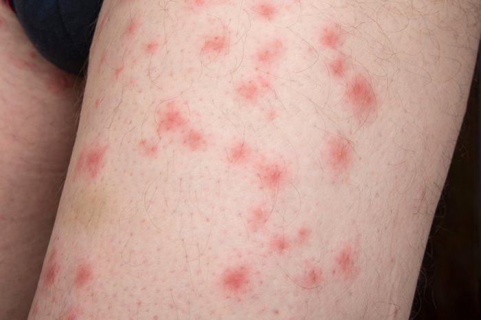 Bed Bug Bites on an Arm
