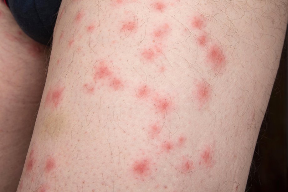 Bed Bug Bites on an Arm